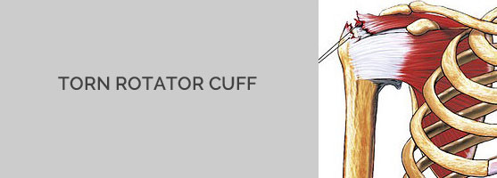 torn rotator cuff diagram
