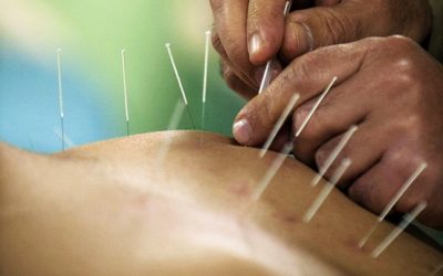 Instant Pain Relief with Dry Needling