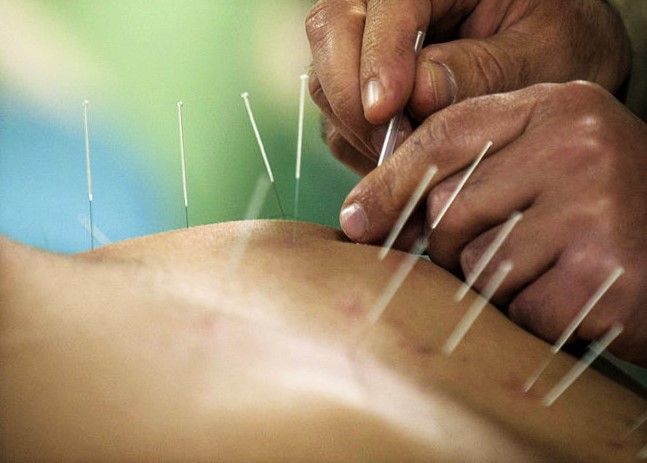 Instant Pain Relief with Dry Needling