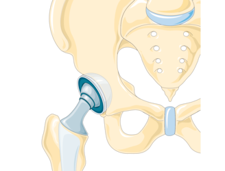 Hip Replacement – Exercises and Other Strategies to Boost Recovery