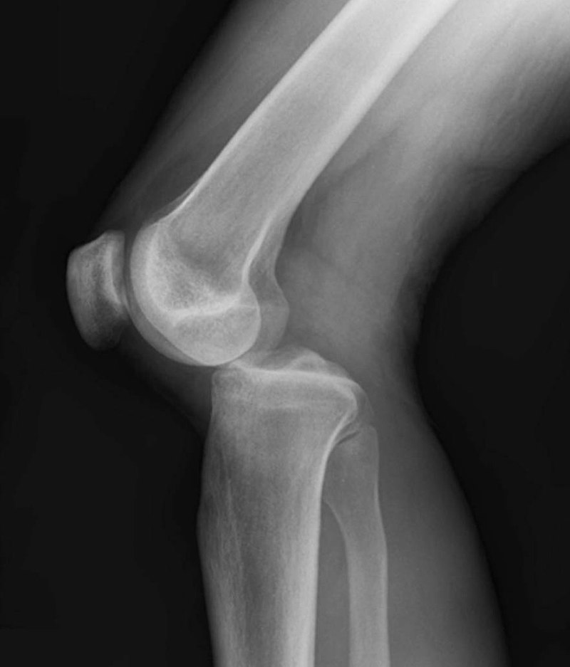 Knee Dislocation Xray Wikipedia